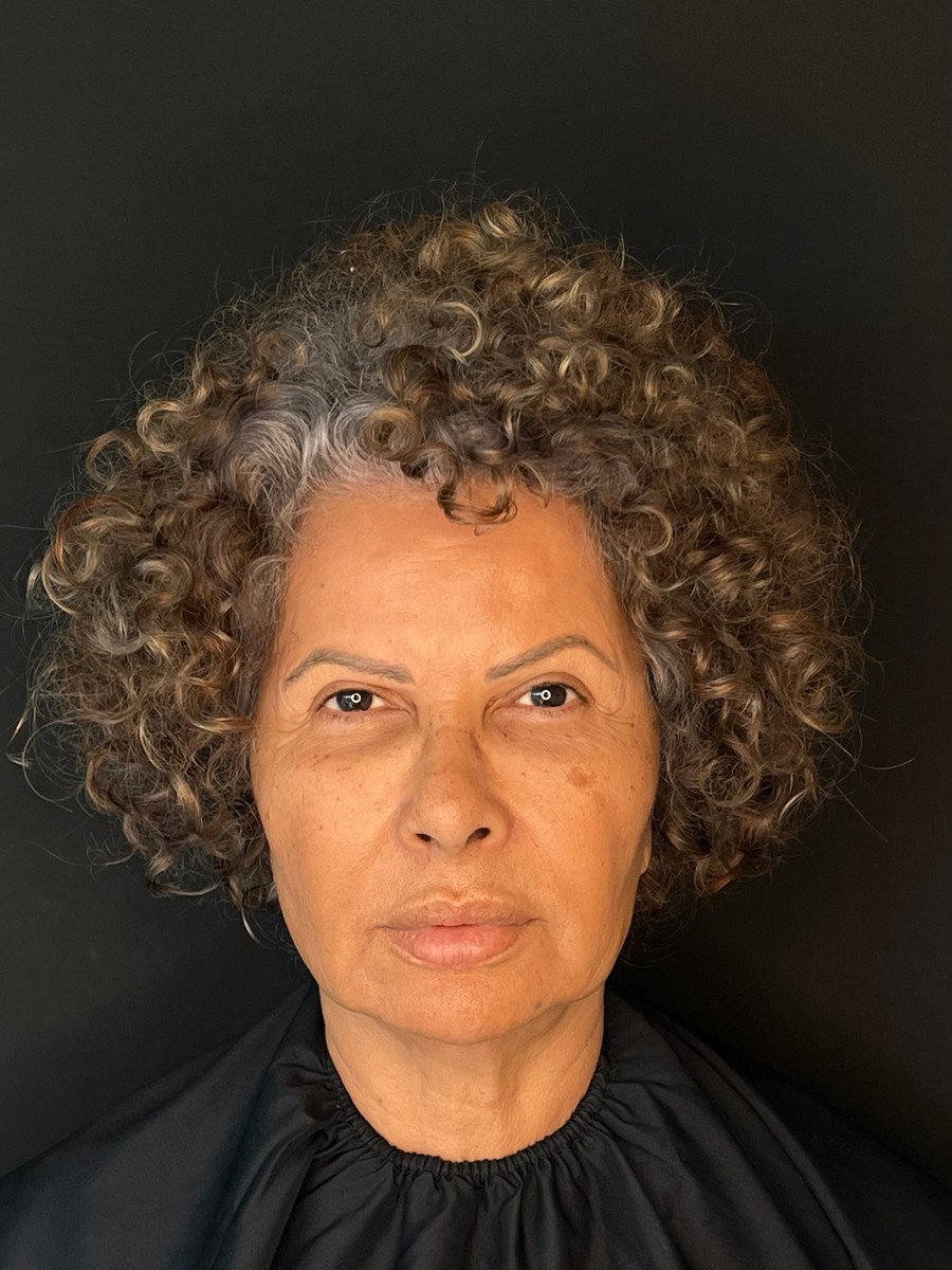 Antes harmonização facial
