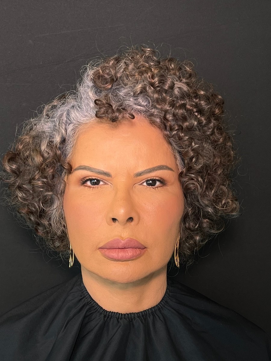 Depois harmonização facial